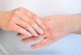 Aprueban por primera vez un remedio biol�gico contra la dermatitis at�pica