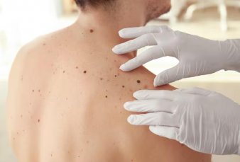 Ya est disponible la vacuna argentina para tratar el melanoma de alto riesgo